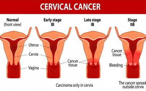 Cervical cancer: 5 signs never to ignore